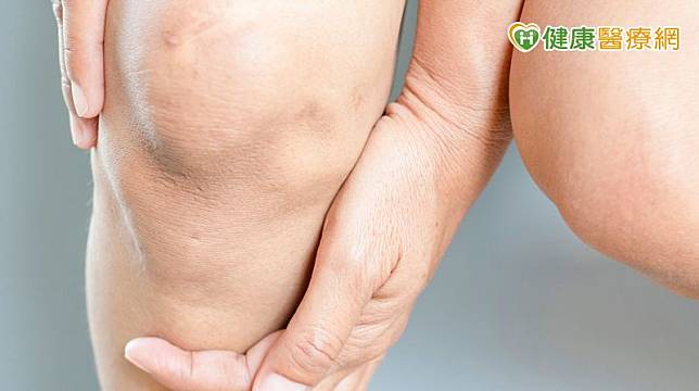 嚴重退化性膝關節炎，ROSA機械手臂輔助成功置換人工膝關節。