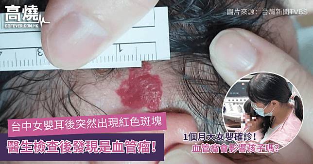 【血管瘤】台中女嬰耳後突然出現紅色斑塊 醫生檢查後發現是血管瘤！