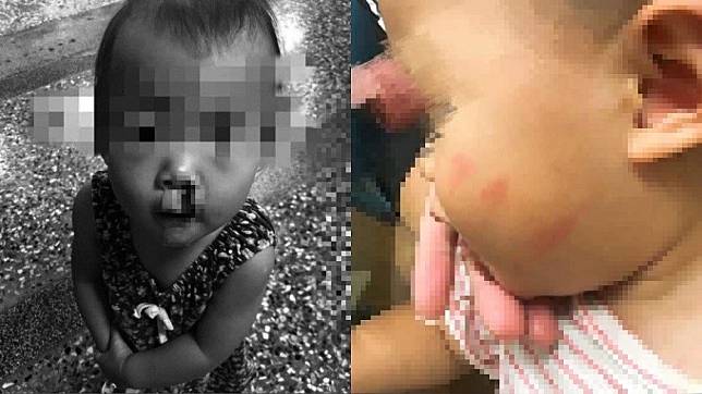 女童母親貼出女兒傷勢照，不僅流鼻血，臉上還有巴掌痕。（圖／翻攝自臉書社團「爆料公社」）