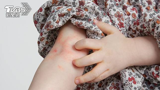 異位性皮膚炎患者，經常在秋冬好發。（示意圖／shutterstock達志影像）