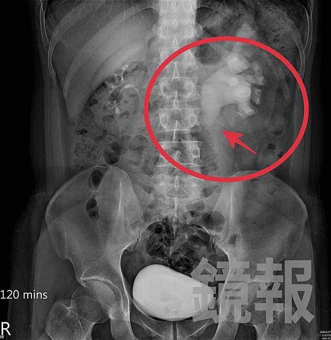 王姓廚師因輸尿管結石(箭頭處)併發腎水腫(紅圈處)，導致腰部劇痛難以行走。亞大附醫提供