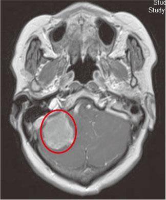 何太右邊小腦的肺癌轉移腫瘤（紅圈，左右反轉）。（作者提供）
