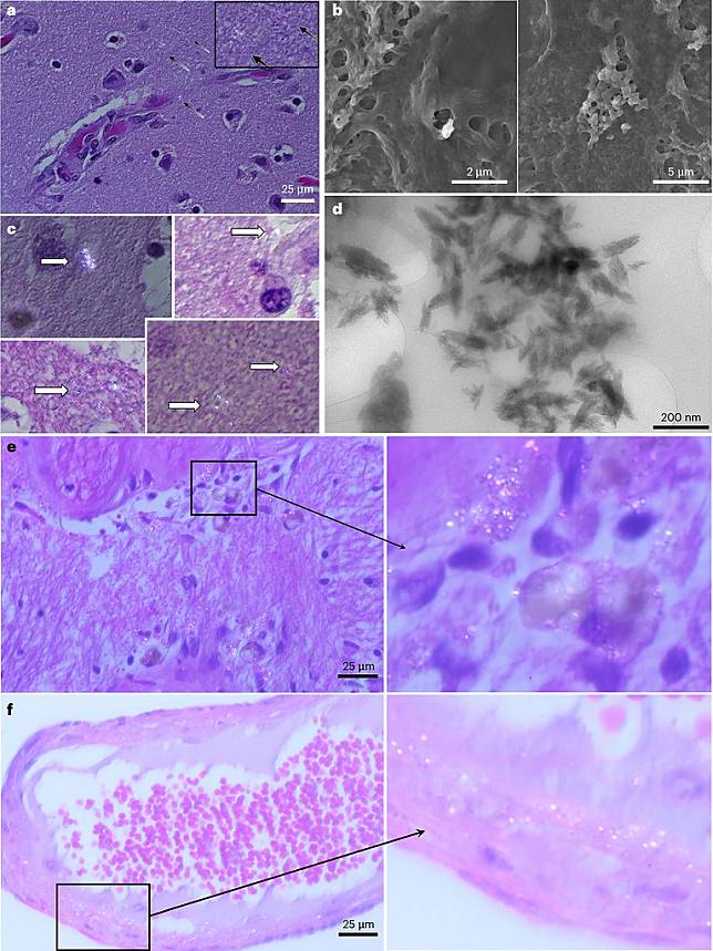 人腦中的微塑膠。圖片來源：Nature Medicine （CC BY-NC-ND 4.0）