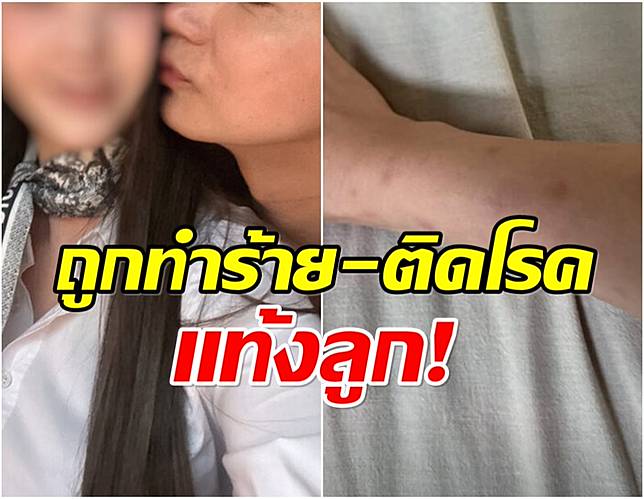 รักขมปี๋ อดีตเเฟนสาวพระเอกดังเเฉยับ โดนทุบตีจนตัวเขียวช้ำ