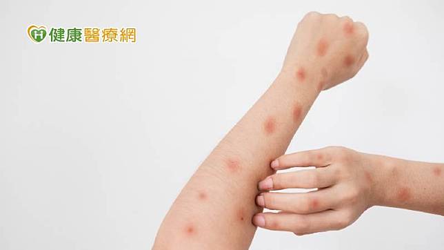 疾管署提醒，確診民眾應遵循所有事項至全部皮疹癒合、結痂脫落且長出新皮膚為止，照顧自己也保護他人。