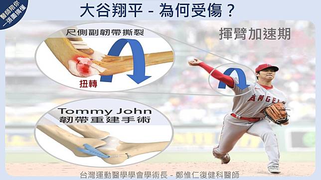 大谷翔平尺側副韌帶撕裂原因與 Tommy John 韌帶重建手術，台灣復健醫學會提供。