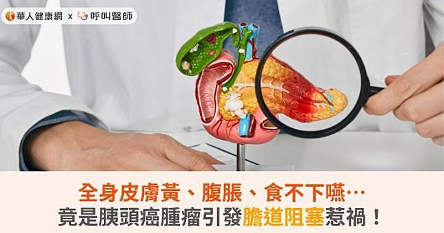 全身皮膚黃、腹脹、食不下嚥…竟是胰頭癌腫瘤引發膽道阻塞惹禍！