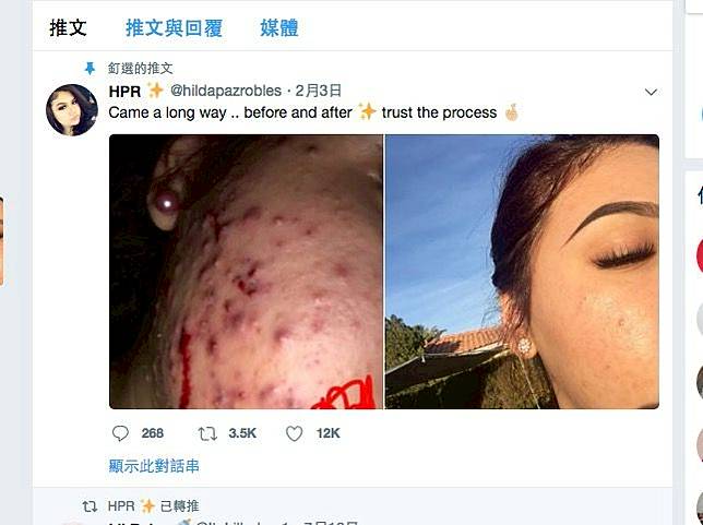 外國女生靠綠茶治暗瘡！
