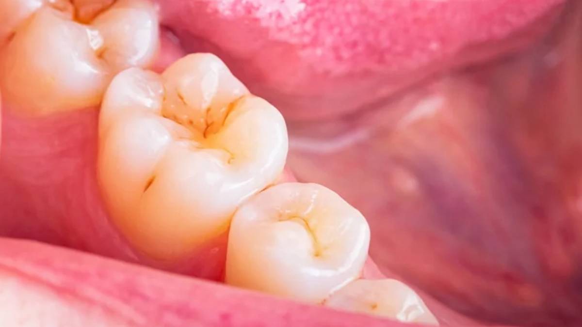 【情報快遞】亞洲人牙齒老得快？「2招」檢視琺瑯質