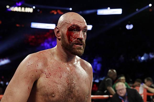Tyson Fury suffered a badly damaged right eye in the grinding win over Sweden’s Otto Wallin. Photo: AP