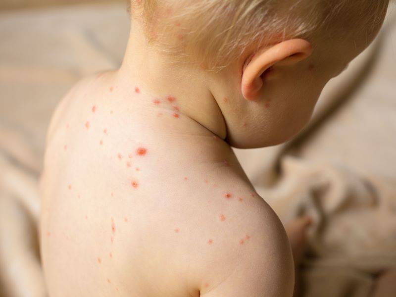 Identifying and Preventing Baby Rash Diseases: A Guide for Parents