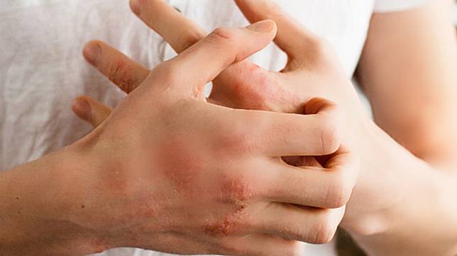 ▲常見缺水造成的皮膚乾癢外，醫師表示近期手部乾裂患者也增加。 