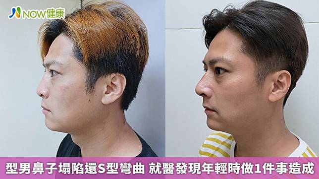 ▲陳先生近5年卻發現鼻子外觀有點塌，甚至正面看起來鼻型有扭曲的狀況。隨之而來也有鼻塞的症狀，連睡覺都鼻塞，除了打乎更影響睡眠品質。（圖／三軍總醫院耳鼻喉部暨醫美中心提供）