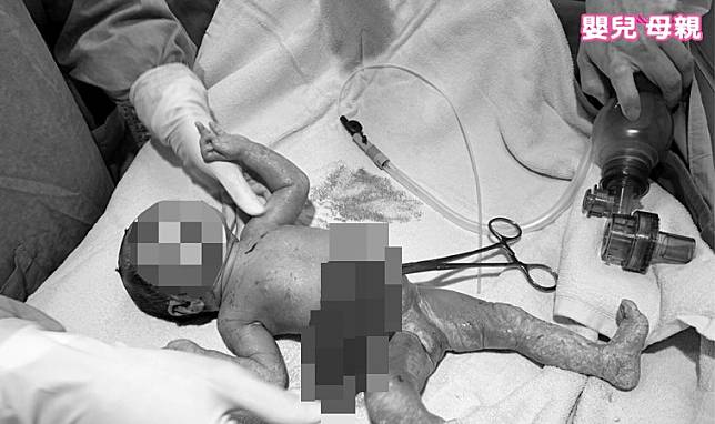 嬰兒一出生就動手術只因罹了這種病，好在定期產檢救了他的一命
