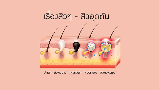 ทำอย่างไรเมื่อเป็นสิวอุดตัน ? สาเหตุของการเกิดสิวอุดตัน กำจัดสิวอุดตันด้วยวิธีต่างๆ