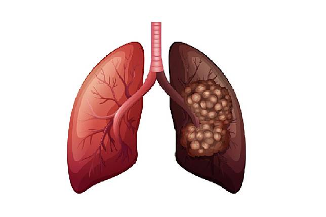 久咳不癒 聲音改變～9個不可忽視的肺癌警訊