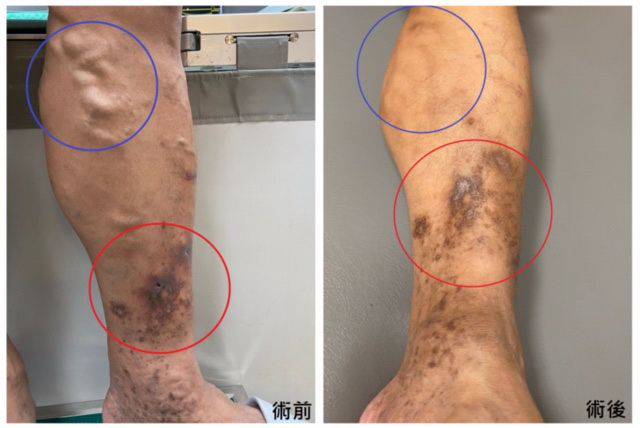 睡醒滿床都是血　靜脈曲張爆裂惹禍