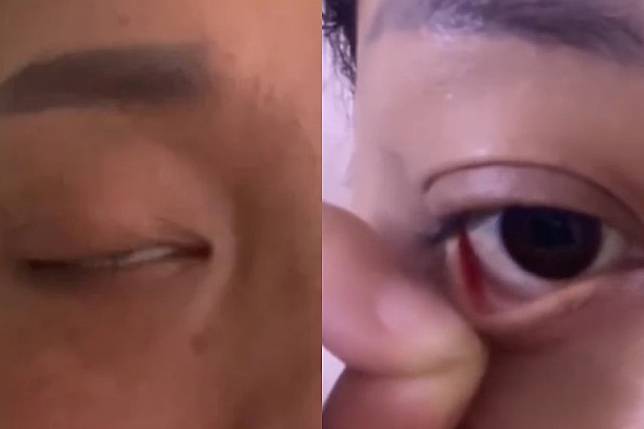 中國女子割眼袋結果眼睛從此無法閉上。（圖／翻攝自微博）