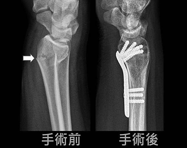 母愛噴發 孕婦清醒局麻手術治斷手