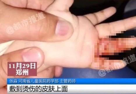 中國河南有一名阿嬤，聽信偏方自製老鼠油敷在孫子燙傷傷口上，導致孩子嚴重感染送醫。（圖片翻攝／城市報導）