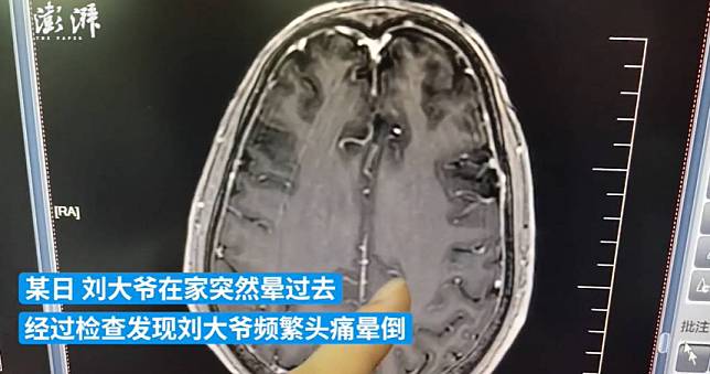 吃豬血！六旬男頭暈昏倒數次　醫一看：大腦爬滿寄生蟲