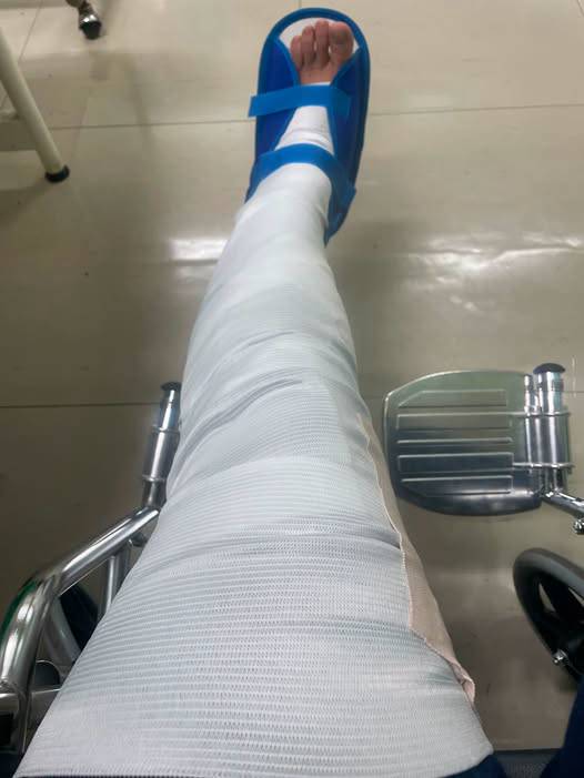 陳玉珍出事了！整條左腿「石膏包緊緊」輪椅照曝光…哀喊：疼痛難耐無法站立