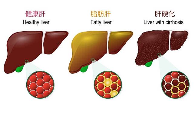 您的肝臟有毒嗎? 簡單自我檢測與4點排毒