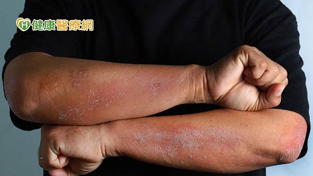 中醫診所院長賴睿昕中醫師認為濕疹是一種慢性發炎性的皮膚病，可發生於身體任何部位