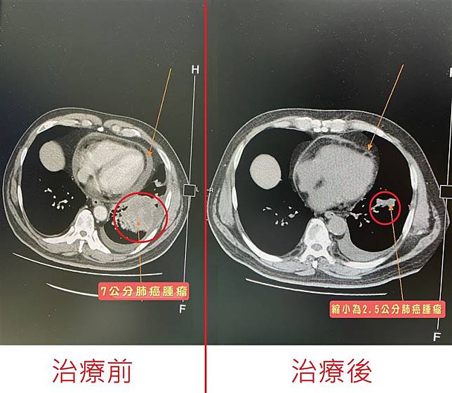 56歲小黃運將一開車就喘檢查竟患肺腺癌末期| 三立新聞網| LINE TODAY