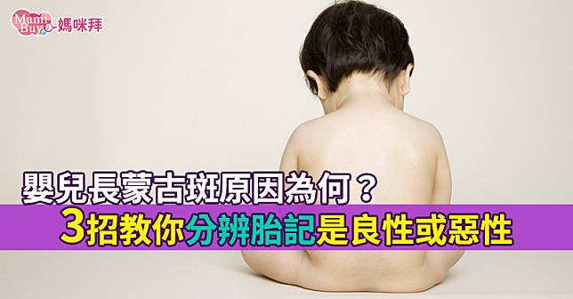嬰兒長蒙古斑原因為何？3招教你分辨胎記是良性或惡性