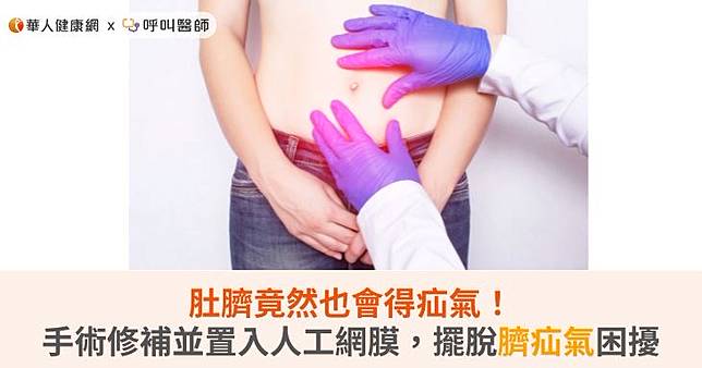肚臍竟然也會得疝氣！手術修補並置入人工網膜，擺脫臍疝氣困擾