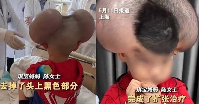 3歲男童頂「米奇頭」巨痣！琪寶與母親的抗痣之路令人動容，「我們不是天生堅強，是擦乾眼淚往前走出來的」