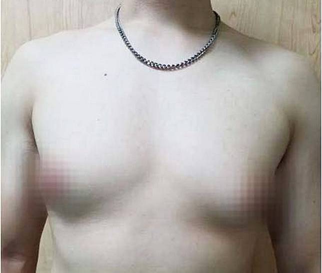 陳姓男子罹患「男性女乳症」，減重後胸部仍相當明顯。（記者陳金龍翻攝）