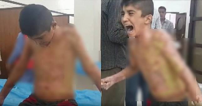 怵目驚心！敘利亞遭化武轟炸　5歲童皮膚剝落痛哭：可不可以停止爆炸？
