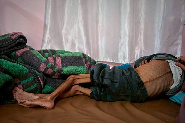 加薩走廊汗尤尼斯的納瑟醫院中，5歲男童拉卡瘦骨嶙峋，每節脊椎清晰可見。美聯社