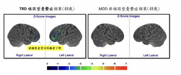 對於藥物治療反應不佳的TRD患者(左圖)，其大腦皮質活性下降的情況較一般憂鬱症患者(右圖)更為顯著。(北榮提供)