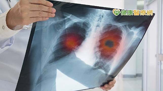 楊崇安醫師說明，目前檢查上可藉由低劑量電腦斷層偵測早期肺癌，不僅低輻射曝露，也能偵測到0.3至0.5公分大小的腫瘤，若能越早發現肺癌，治療效果也越好。