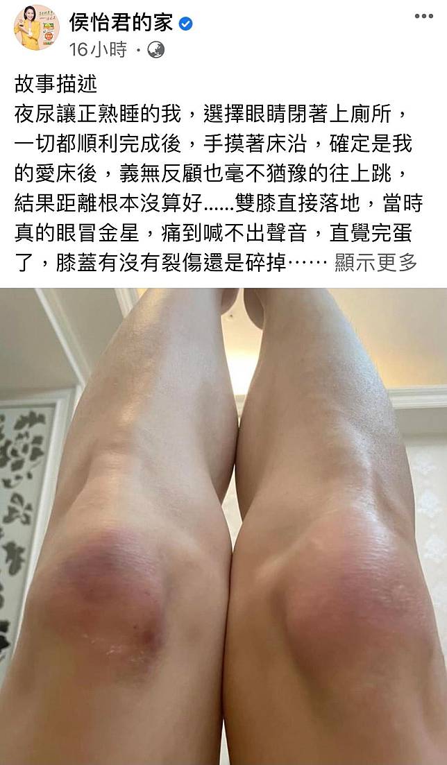 侯怡君貼出自己雙膝瘀青照片，讓人不忍直視。（翻攝自侯怡君臉書）