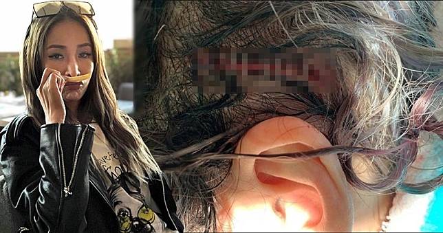 蕭亞軒突然在社交平台分享去年10月頭部受傷的照片。（蕭亞軒Instagram圖片 / 明報製圖）