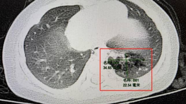 肺部陰影竟是「肺隔離症狀」。（圖／翻攝自@揚子晚報　微博）