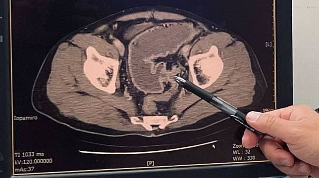 電腦斷層顯示出腫瘤塞住了腸道。新泰綜合醫院