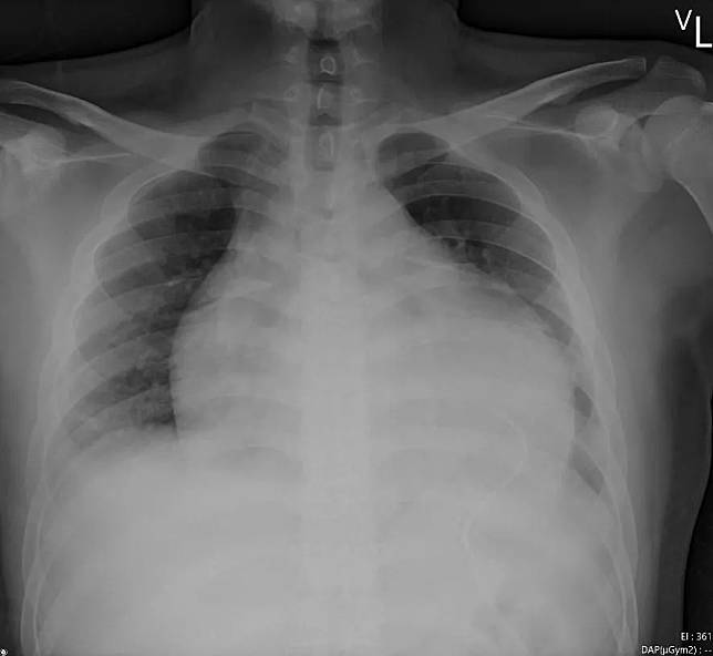 胸部X光可見心臟嚴重擴大，放置引流管減少積水，並以支持式療法治療。（圖／花蓮慈濟醫院）