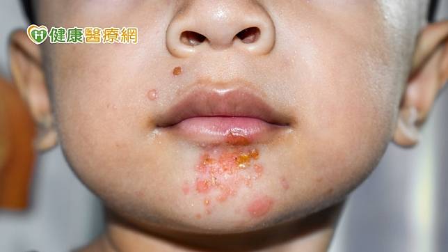 膿痂疹的病灶常出現在臉部，患部可能會癢會痛，部分嘴唇會出現腫脹，主要的表現是在鼻子、嘴巴周圍觀察到金黃色的結痂，看起來有點像乾掉的蜂蜜黏在皮膚上。