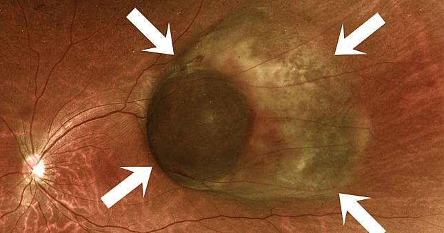 成人最常見眼內惡性腫瘤黑色素惡性瘤／圖片來源：周宏達醫師