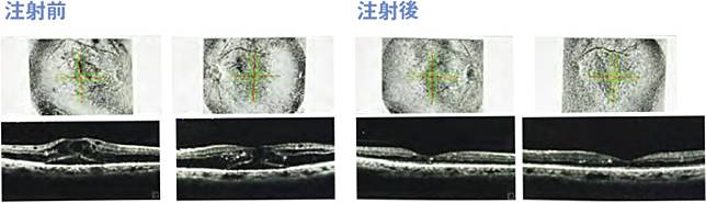 比較注射前和注射3針雙抗藥物後5個月的黃斑水腫厚度掃描影像，可見黃斑厚度大減，即代表水腫消退。（作者提供）