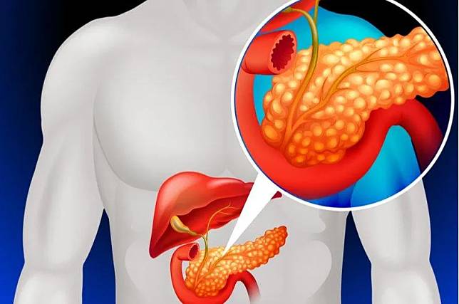 根據衛福部最新公布的112年國人十大死因報告，癌症已連續42年居十大死因首位，並且胰臟癌的死亡人數與死亡率持續上升。（示意圖／pexels）