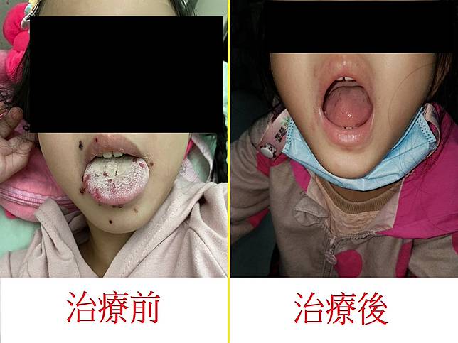 醫師說急性疱疹性齒齦口腔炎，症狀容易與腸病毒搞混。（圖：烏日林新醫院提供）