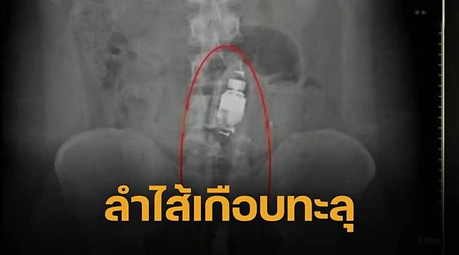 เกือบตาย หนุ่มซี้ด แฟนยัดแท่งยักษ์ 20 ซม. ทะลวงทวารหนัก เสร็จชิ่งหนี ทิ้งให้สั่นค้างคืน