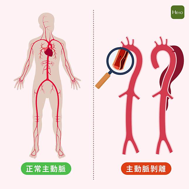 主動脈剝離分為甲型（A型）與乙型（B型）。甲型剝離的位置包含升主動脈（如放大鏡所示），靠近心臟所以更加危急。