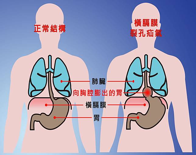 仁波切橫膈膜裂孔疝氣胃食道逆流痼疾　微創手術修補